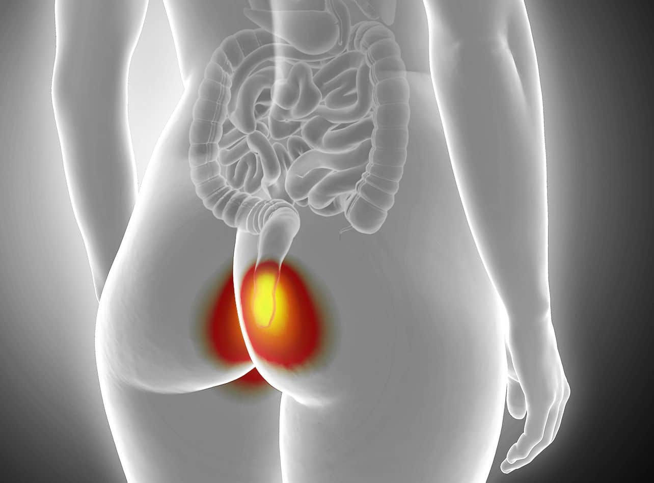 Chirurgie Proctologique